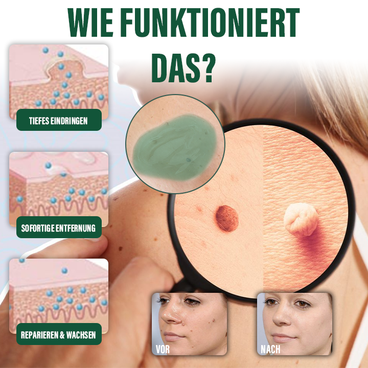 Ceoerty® DermaErase Sofort-Gel zur Entfernung von Muttermalen und Hautflecken