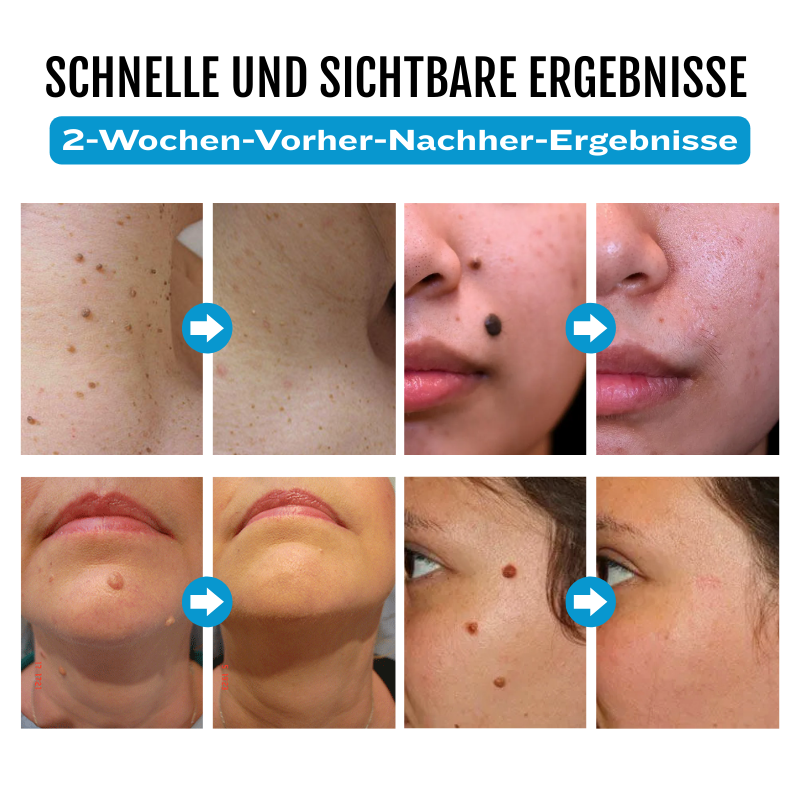 Bikenda® SpotlessDerm Molen- und Warzen-Laserstift
